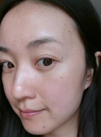 去眼袋手术