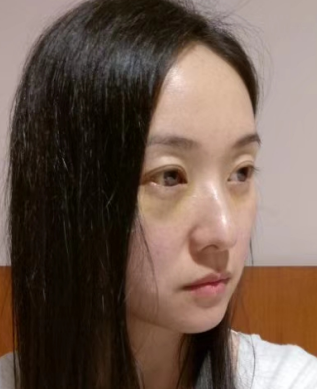 去眼袋手术