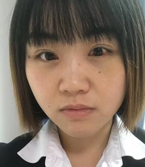 去眼袋手术
