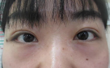去眼袋手术