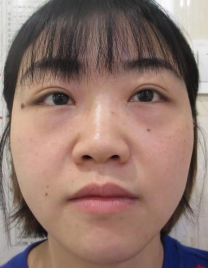 去眼袋手术