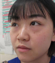 去眼袋手术
