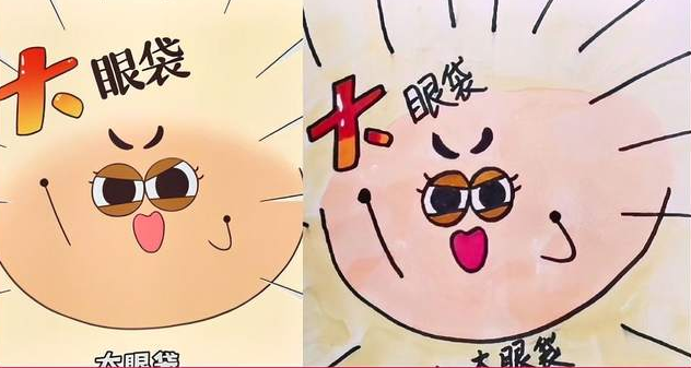 去眼袋手术