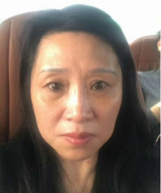 去眼袋手术