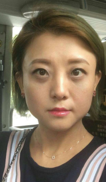 去眼袋手术