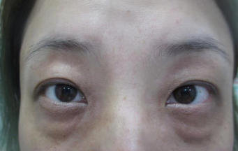 去眼袋手术