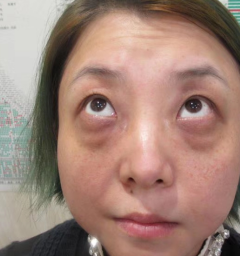 去眼袋手术