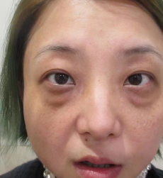 去眼袋手术