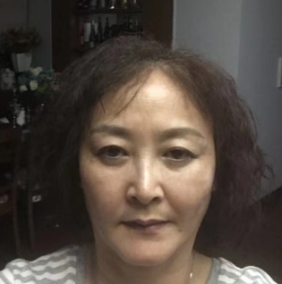 去眼袋手术