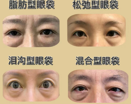 去眼袋手术