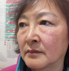 去眼袋手术