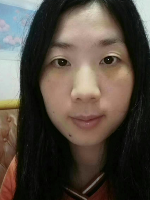 去眼袋手术