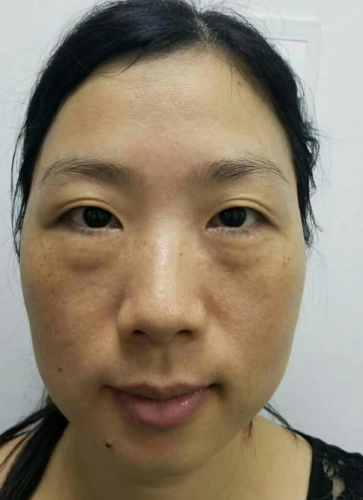 去眼袋手术