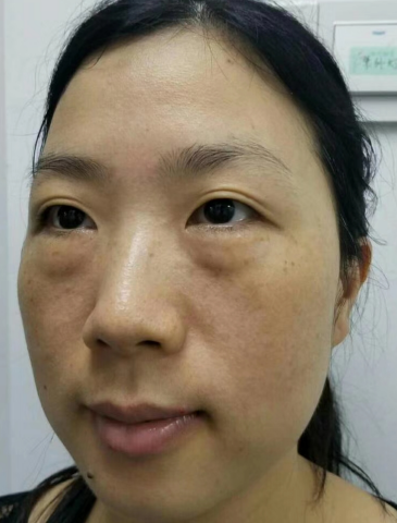 去眼袋手术