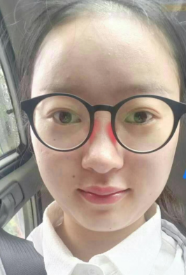 去眼袋手术