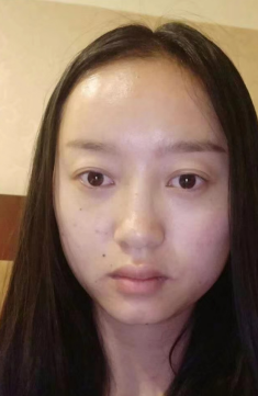 去眼袋手术
