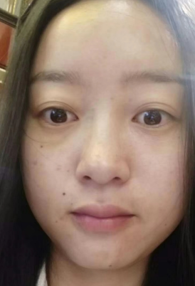 去眼袋手术