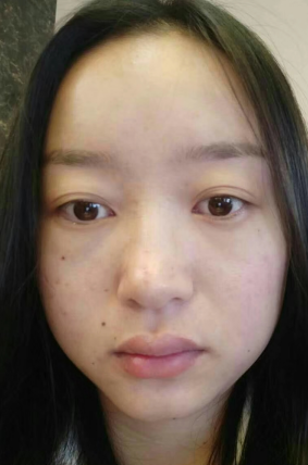 去眼袋手术