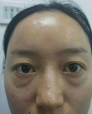 去眼袋手术