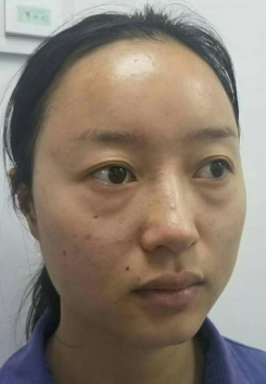 去眼袋手术