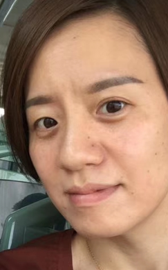 去眼袋手术