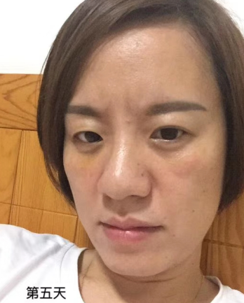 去眼袋手术