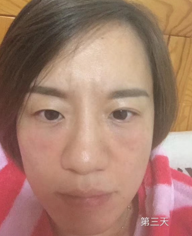 去眼袋手术