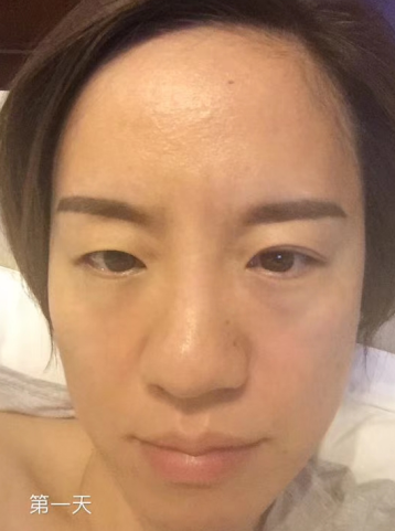 去眼袋手术