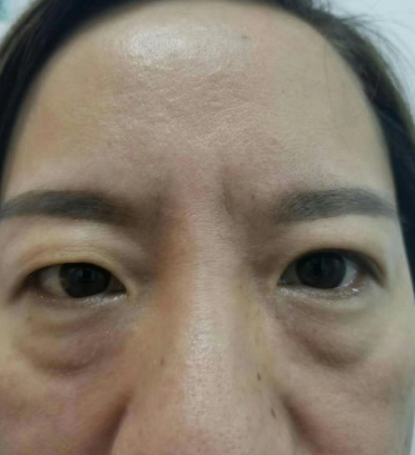 去眼袋手术