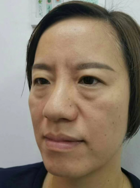 去眼袋手术