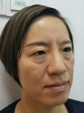 去眼袋手术