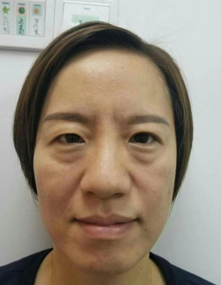 去眼袋手术