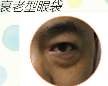 去眼袋手术