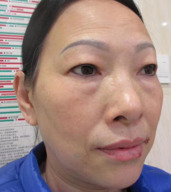 去眼袋手术