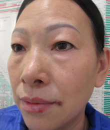 去眼袋手术