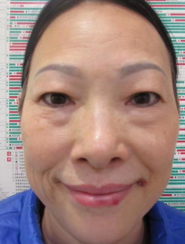 去眼袋手术