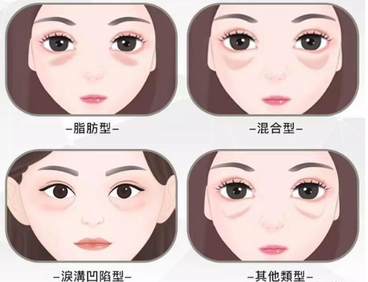 去眼袋手术