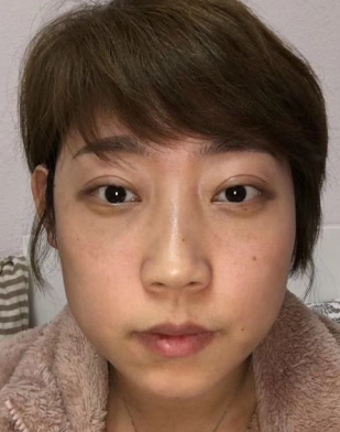 去眼袋手术
