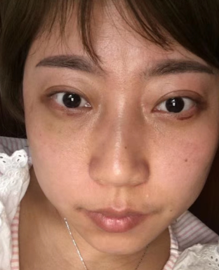 去眼袋手术