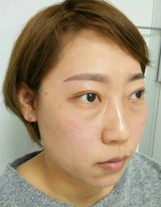 去眼袋手术