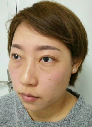去眼袋手术
