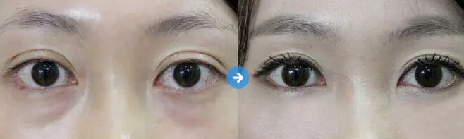 去眼袋手术