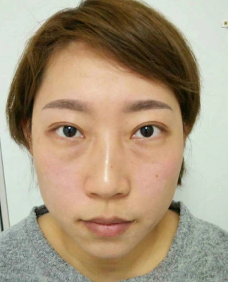 去眼袋手术