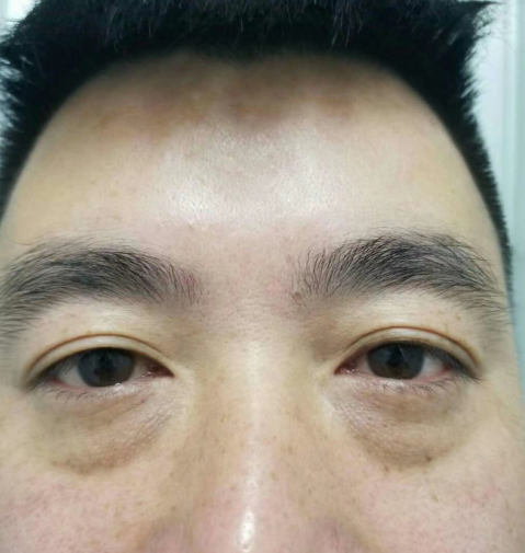 去眼袋手术