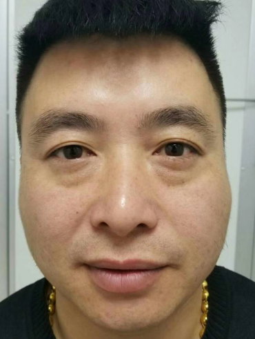去眼袋手术