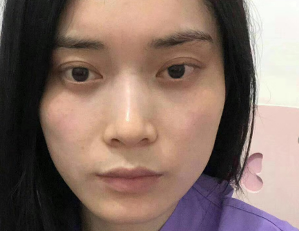 去眼袋手术