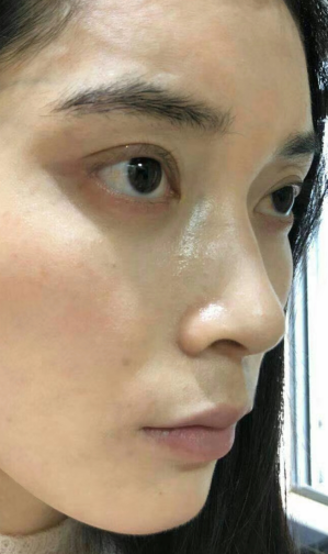 去眼袋手术