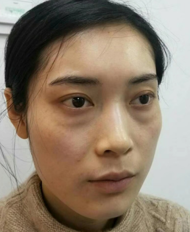 去眼袋手术