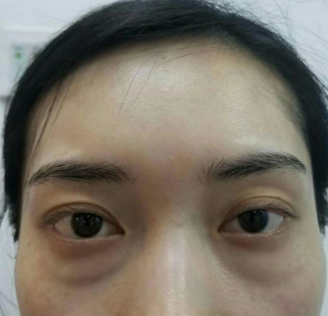 去眼袋手术