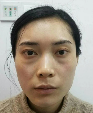 去眼袋手术